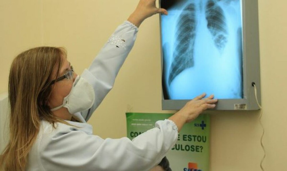Propostas incluem a garantia de investimento público para estratégias do Plano Nacional pelo Fim da Tuberculose